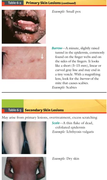 Table 6-3 Secondary Skin Lesions