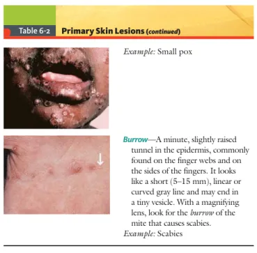 Table 6-2 Primary Skin Lesions  ( continued )