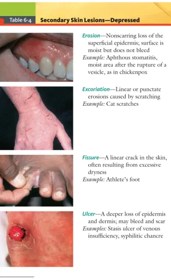 Table 6-4 Secondary Skin Lesions—Depressed