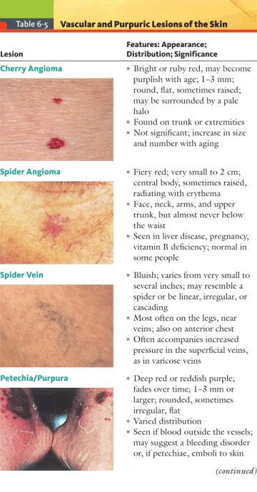 Table 6-5 Vascular and Purpuric Lesions of the Skin