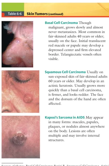 Table 6-6 Skin Tumors  ( continued )