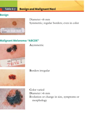 Table 6-7 Benign and Malignant Nevi Benign