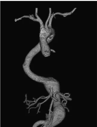 Figure 12.1       Computed  tomography  angiogram  of  a  young  woman with Marfan syndrome