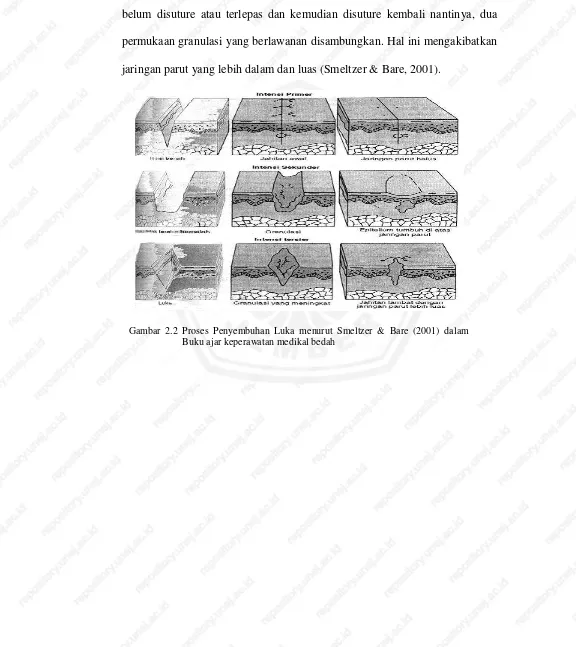 Gambar 2.2 Proses Penyembuhan Luka menurut Smeltzer & Bare (2001) dalam 