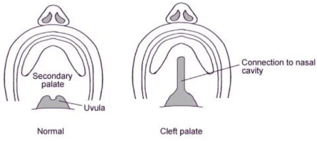 Fig. 8  Showing contrast between a normal and cleft palate 