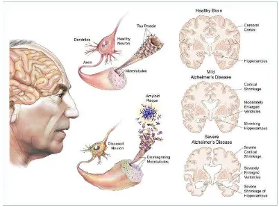 Gambar 1. Kondisi otak Sumber: http://drjockers.com/ Alzheimer 