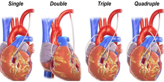 Gambar 1 Coronary Artery Bypass Graft