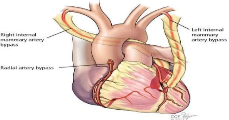 Gambar 2. Left Interna Mamaria Arteri 