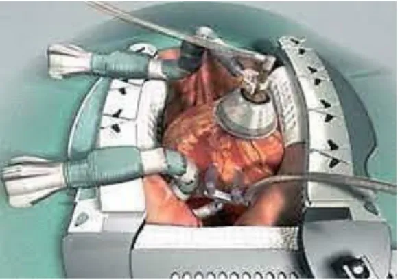 Gambar 5. Off-Pump Coronary Artery Bypass (OPCAB) 