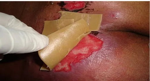Gambar 2.9. Hydrocolloid dressing pada luka dengan eksudat minimal