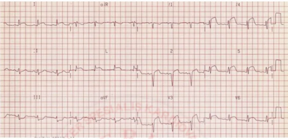 Gambar 2. STEMI Extensive anterior wall ( ST elevasi di V2-V6, I, aVL)