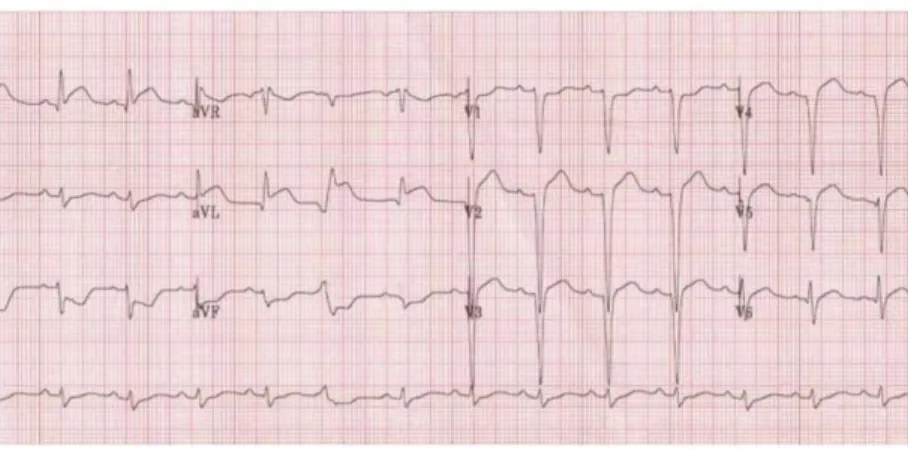 Gambar 4. STEMI High lateral (ST elevasi di leas I, aVL)
