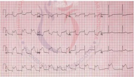 Gambar 3. STEMI Inferior ( ST elevasi di II, III, aVF)