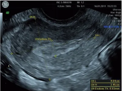 Fig. 2.1   Longitudinal view demonstrating regular thickened endometrium