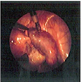 Fig. 5.2   Linear salpingostomy reveals the products of conception inside the  fallopian tube, seen by laparoscopy