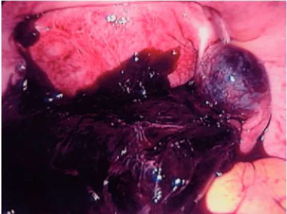 Fig. 6.2   Injecting dilute vasopressin solution into an adherent and bleeding  ectopic pregnancy
