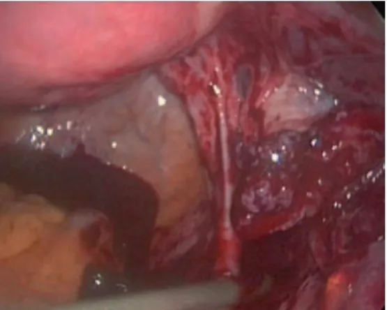 Fig. 6.4   Continued bleeding and abnormal tubal anatomy that could not be  salvaged led to the final decision to perform salpingectomy
