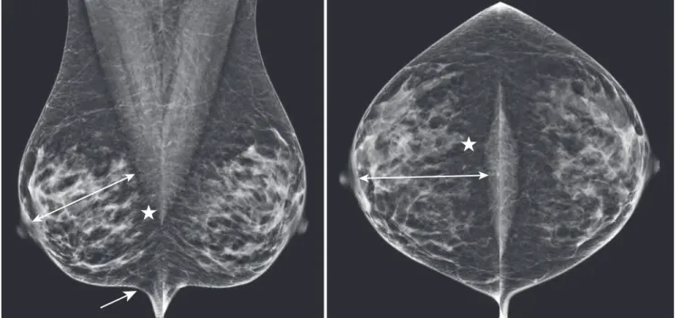 FIG. 1.11  Positioning for a normal mediolateral oblique (MLO)  mammogram. By convention, the view type and side (R, right; 