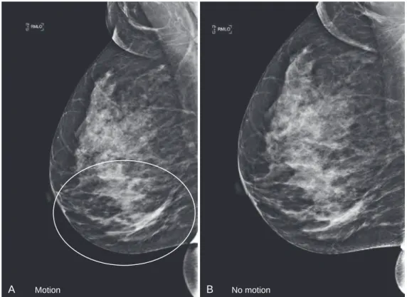 FIG. 1.23  Motion artifact on digital mammography. (A) Right mediolateral oblique (RMLO) view shows blurred  breast tissue most evident in lower breast (circle)