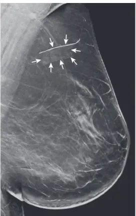 FIG. 1.27  Out-of-plane artifacts on tomosynthesis. Tomosynthe- Tomosynthe-sis-synthesized two-dimensional (2D) image shows multiple lines  (arrows) under the linear scar marker that were caused by ghost  artifacts from the metallic marker in out-of-focus 