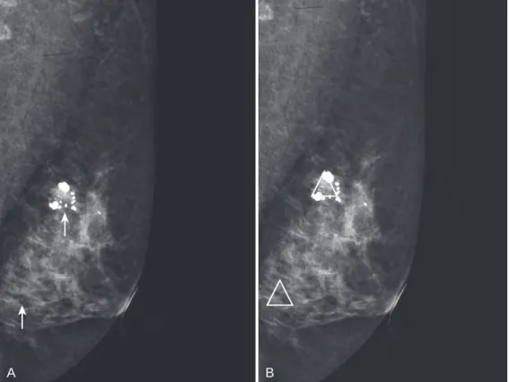 FIG. 1.30 Computer-aided detection (CAD). (A) Left digital mediolateral oblique mammogram before CAD  shows calcifications (arrows)