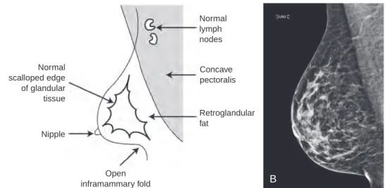 FIG. 2.3  Normal breast anatomy and correlative mammograms. (A) Schematic of a normal mediolateral oblique  (MLO) mammogram