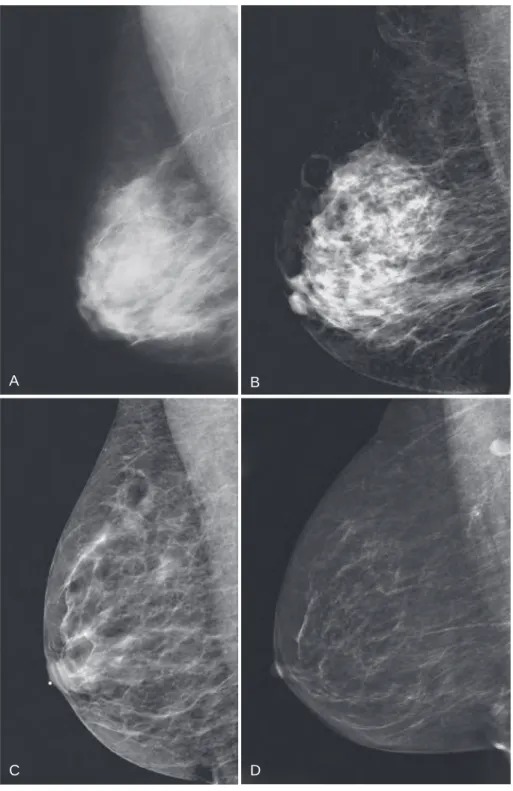 FIG. 2.6  Mammograms of normal breast density. BI-RADS 2013 lexicon classifies breast density into four types