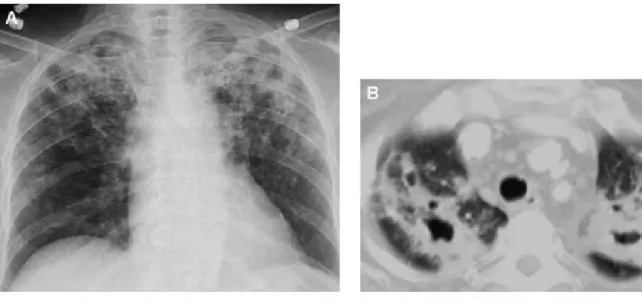 Gambar 4. TB paru post primer pada pasien dengan immunodefisiensi.