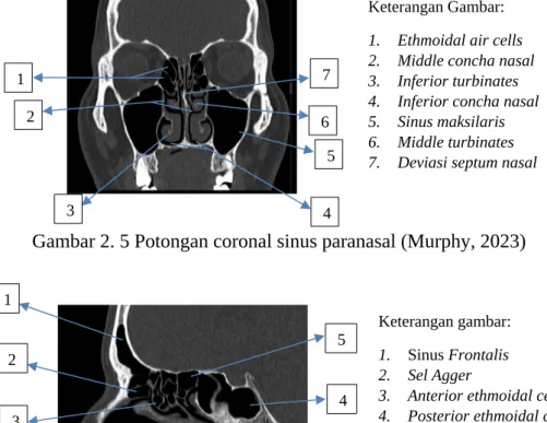 Gambar 2. 5 Potongan coronal sinus paranasal (Murphy, 2023)