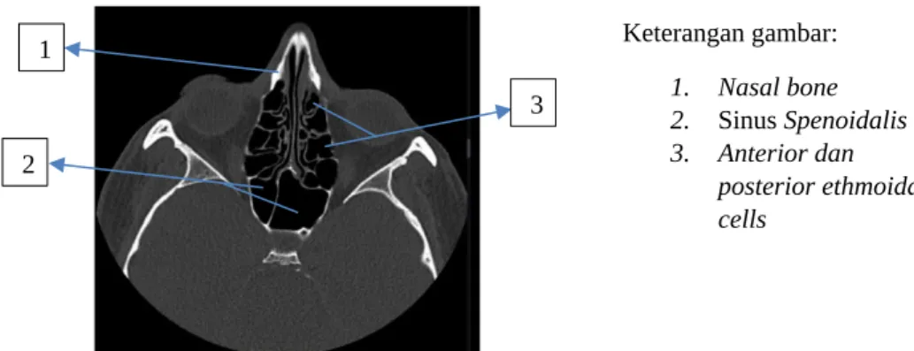 Gambar 2. 7 Potongan axial sinus paranasal (Murphy, 2023)