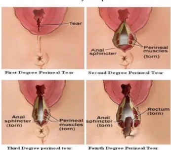 Gambar 2.1 Derajat Ruptur Perineum