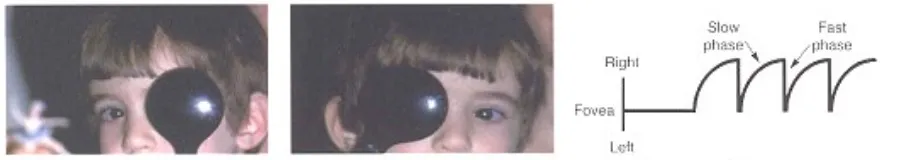 Gambar 12. Kiri: Kepala anak menoleh ke kanan sewaktu berfiksasi dengan mata kanan. Titik