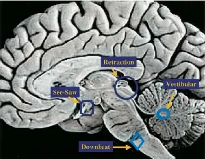 Gambar 13. Area pada otak yang terlibat dalam terjadinya nistagmus didapat. 1