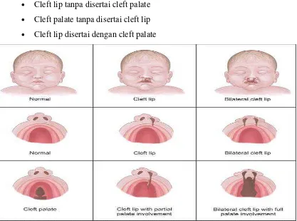 Gambar 1. Perbedaan antara keadaan normal, cleft lip, dan cleft palate (Klik dokter. 2008)