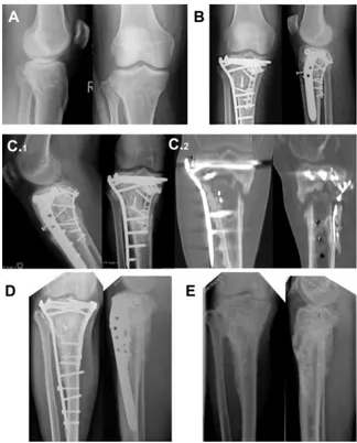 Gambar  1.  Terapi  sukses  pada  kasus  non- non-union dengan rhBMP-2 (A) radiografi setelah  fraktur;  (B)  Tatalaksana  fraktur  tanpa  rhBMP-2;  (C)  Terjadi  non-union  (C.1)  dengan CT-scan pada C.2; (D) Penyembuhan  setelah  revisi  dengan  re-osteo