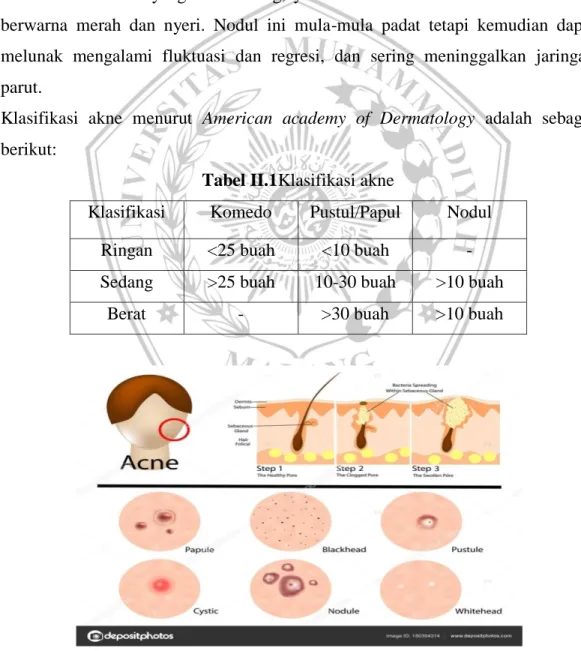Tabel II.1Klasifikasi akne 