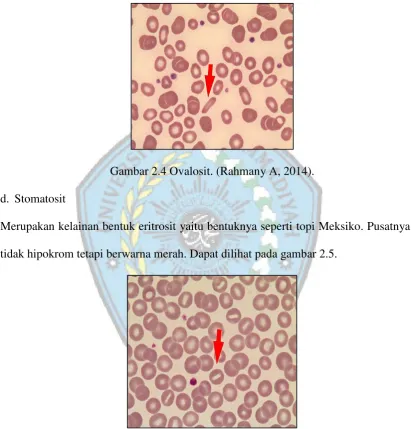Gambar 2.4 Ovalosit. (Rahmany A, 2014). 