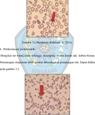 Gambar 3.1 Hipokrom (Rahmany A, 2014). 