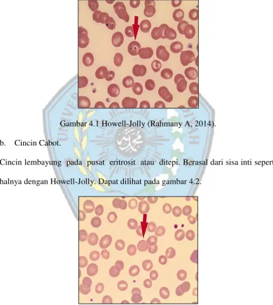 Gambar 4.1 Howell-Jolly (Rahmany A, 2014). 