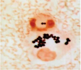 Gambar 1. Bentuk Mikroskopis S.aureus dalam sampel dahak (Lowy, 2014) 