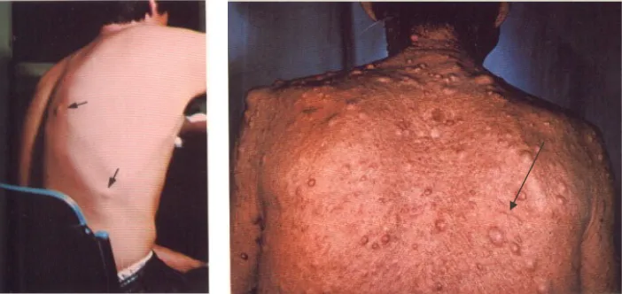 Gambar 7. Penderita Sistiserkosis dengan nodul-nodul ditubuhnya                          (Ridhawati 2000)