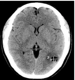 Gambar 10. Hasil MRI dari kasus neurosistiserkosis (Kraft 2007)