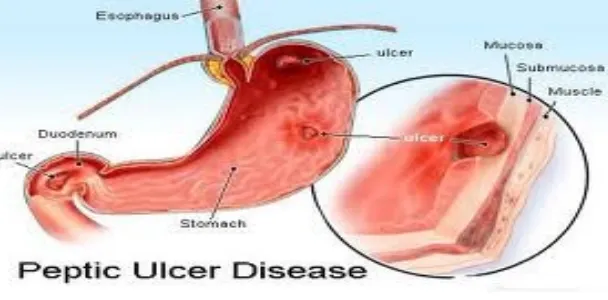 Gambar 2.3 Peptic ulcer