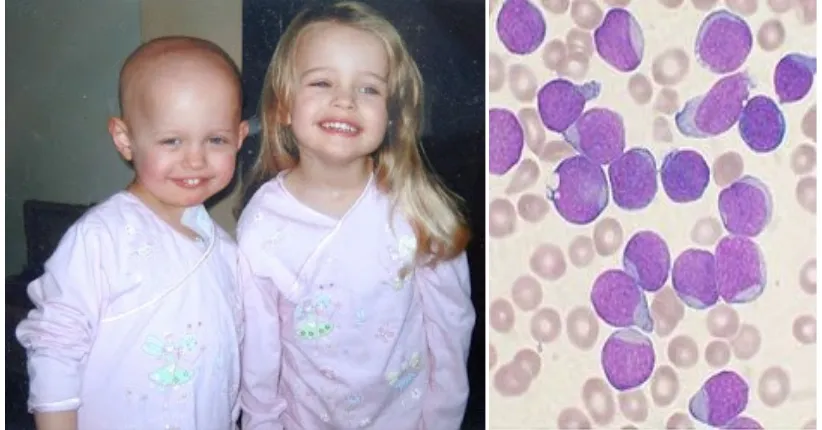 Gambar penderita leukemia dan keadaan darah penderita