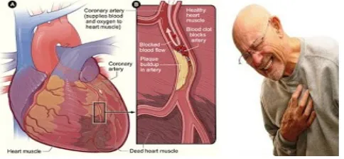 Gambar penderita jantung koroner