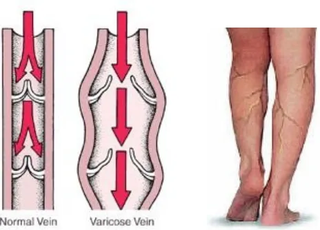 Gambar Vena penderita varises dan kaki penderita varises