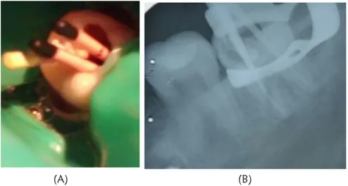 Gambar 4. Pengepasan gutta percha sesuai panjang kerja A) tampak klinis; B) radiograf.