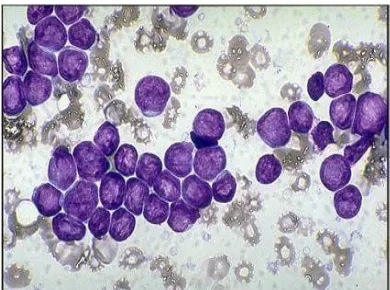 Gambar 2 : Leukemia limfoblastik akut tipe L-1(Arceci et al, 2007) 
