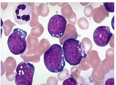 Gambar  4: Leukemia limfoblastik akut tipe L-3 (Arceci et al, 2007) 