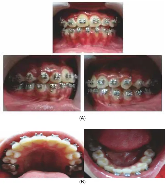 Gambar 6. Gambaran setelah perawatan ortodontik cekat selama 6 bulan, terlihat susunan gigi telah 